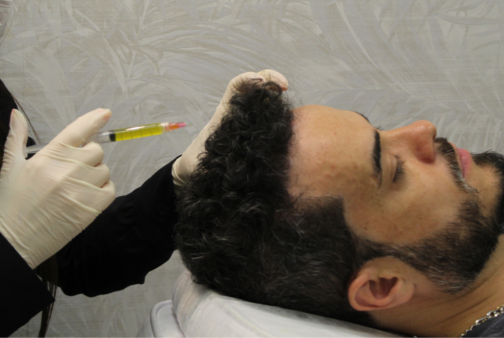 Intradermoterapia_Capilar​