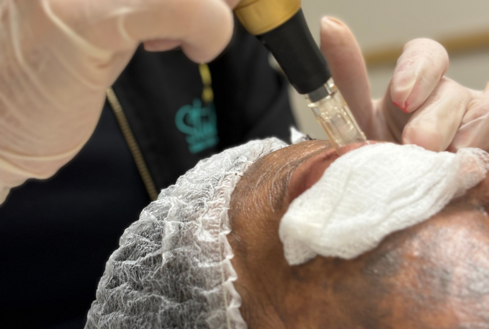 microagulhamento_facial