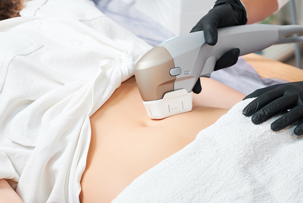 ultraformer corporal