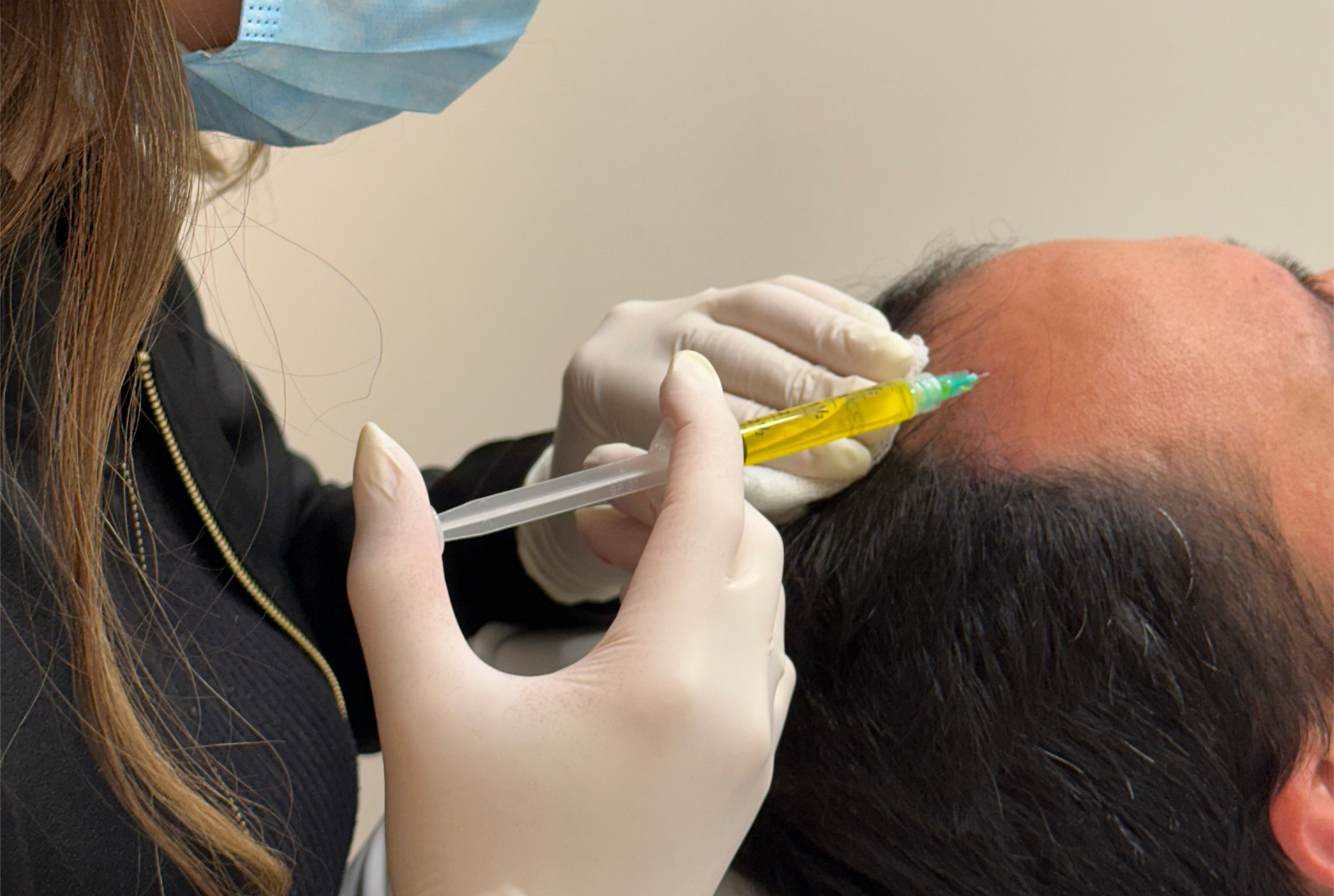 Intradermoterapia_Capilar​